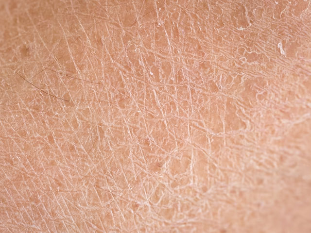 علت اصلی خشکی پوست