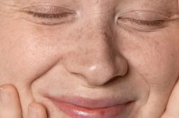 علت ایجاد لکه های پوستی در پوست چرب و درمان آن
